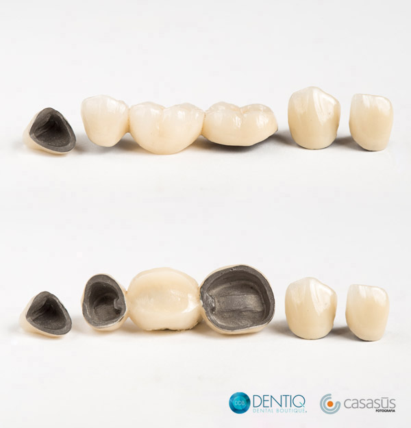 Sintético 104+ Foto Puente De 3 Unidades Metal Porcelana Alta Definición Completa, 2k, 4k 10/2023 Sintético 104+ Foto Puente De 3 Unidades Metal Porcelana Alta Definición Completa, 2k, 4k 10/2023